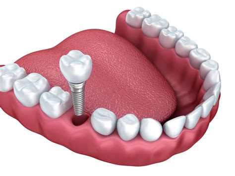 implante dentario|implant dentaire c'est quoi.